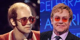 Elton John Hair Transplant Hair Implants Hair Transplant Fue Hair Transplant