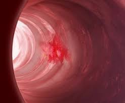 Image result for Colonoscopy in GI Bleeding