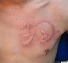 Résultat de recherche d'images pour "scarification"