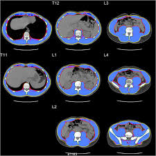 Muscles of the back can be divided into superficial, intermediate, and deep group.since the all the back muscles originate in embryo (fetus) form by locations other than the back, muscles in the. Skeletal Muscle Cutoff Values For Sarcopenia Diagnosis Using T10 To L5 Measurements In A Healthy Us Population Scientific Reports