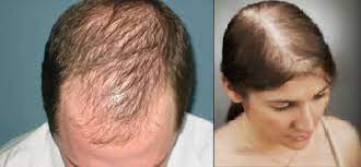 Postpartum Hair Loss You Can Get More Details By Clicking On The Image Hairlosstreatment Hair Loss Women Hair Loss Men Postpartum Hair Loss
