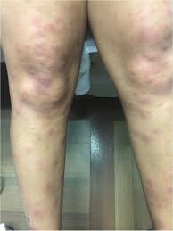 Image result for erythema nodosum
