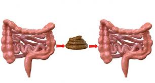 Image result for Fecal Transfer