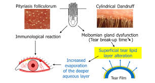 Image result for demodex rosacea