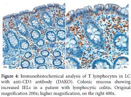 Image result for Microscopic Colitis