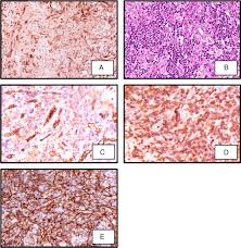 Anubha bajaj* ab diagnostics, new delhi, india. Scielo Brasil A Difficult Case Of Angioimmunoblastic T Cell Lymphoma To Diagnose A Difficult Case Of Angioimmunoblastic T Cell Lymphoma To Diagnose