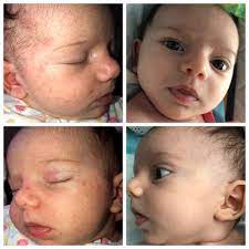 My Daughter Had Really Bad Baby Acne I Used The All Over Ointment And In About 8 Days Her Skin Was Basically Cleared Up I Wo Baby Acne Baby Eczema Baby List