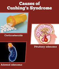 Cushing S Syndrome Causes Symptoms Diagnosis And Management