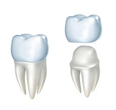 Dental Crowns St Louis Crowns Cwe Clayton U City