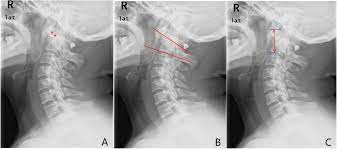 Surgical Treatment Of Atlantoaxial Subluxation By Intraoperative Skull Traction And C1 C2 Fixation Bmc Musculoskeletal Disorders Full Text