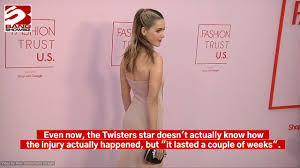 Kiernan Shipka woke up with a ‘massive hump on her nose’ after a ‘big  Christmas mishap’