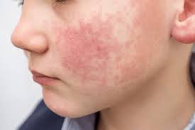 Image result for Scarlet Fever