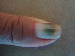 Image result for onychomycosis