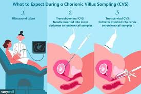 Image result for Chorionic Villus Sampling