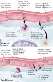 Type 2 Diabetes Mellitus Harvard Health