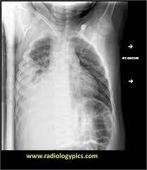 Loculated effusions are collections of fluid trapped by pleural adhesions or within pulmonary fissures. Pin By Nicole Clarke On Excalibur Healthcare S Imaging Teleradiology Pins Pleural Effusion Radiology Schools Radiology