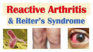 Image result for Poststreptococcal Reactive Arthritis