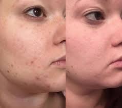 Redness Breakouts And Dry Skin Cower In The Face Of This All Natural Oil Radha Rosehip Oil Acne Treatment Acne Treatment Overnight