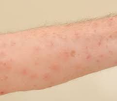 Image result for scabies in the groin area