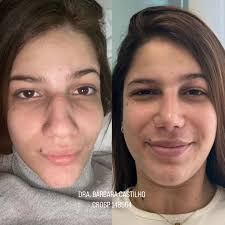 NARIZ + LÁBIO + MENTO = PERFIL PERFEITO 😮‍💨 Apenas 30 minutos separa o  antes do depois 👃🏼👄💉 • Rinomodelação com ácido hialurônico •  Preenchimento labial • Preenchimento de mento DRA. BÁRBARA CASTILHO CROSP  148964