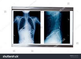 X-ray Frame Anterior View Isolated On Stock Photo 766806490