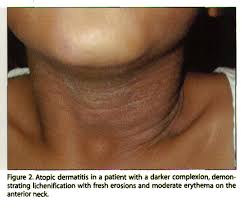 Image result for Atopic Patient