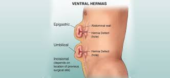 Image result for stomach hernia symptoms
