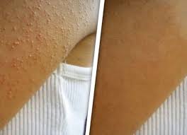Conoce Como Eliminar Los Granos Rojos De Tu Cuerpo