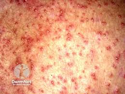 Image result for sweat rash on back