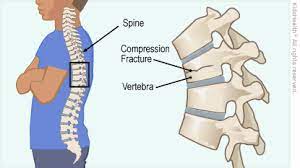Common problems & solutions *. Compression Fracture Of The Spine For Parents Nemours Kidshealth