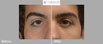 «endoscopic midface lift and cat eye surgery • cat eye surgery refers to several procedures that…» Canthoplasty Photos Mehryar Ray Taban Md