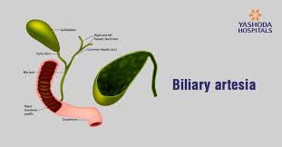 Check spelling or type a new query. How To Treat Biliary Atresia A Rare Digestive Disease In Infants