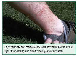 Start treating chiggers in early spring to kill and control the newly hatched pests before they can. Chiggers What Does A Chigger Bite Look Like And How Do You Treat It