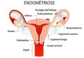 Sauter à la navigation sauter à la recherche. Endometriose Symptomes Diagnotic Traitements Et Risques D Infertilite