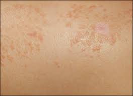 The most secure digital platform to get legally binding, electronically signed documents in just a few seconds. Cutaneous And Pulmonary Sarcoidosis Pulmonology