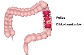 Om de diagnose darmkanker te stellen is meestal een inwendig kijkonderzoek in de dikke darm (coloscopie) nodig. Darmkanker
