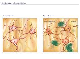 Proteins that form plaques in the brains of alzheimer's patients might also stiffen heart muscle and increase their risk of heart failure, a new study reports. Illustration Amyloide Plaques Und Fibrillen Alzheimer Forschung Initiative E V Afi