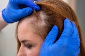 Hair loss treatment result at Mumbra clinic