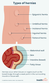 Image result for Hernia Reduction
