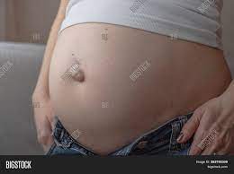 Umbilical Hernia Image Photo Free Trial Bigstock