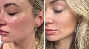 I was frozen, heated and squeezed for bio-hacking treatments loved by  Gwyneth Paltrow and Kendall Jenner