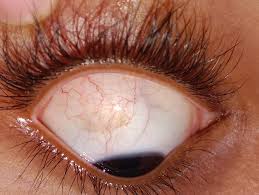 Image result for melanosis sclera