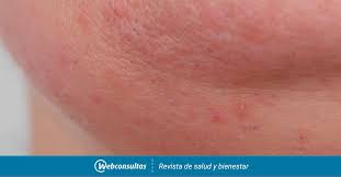 Sintomas De La Alergia Al Huevo Dieta Y Nutricion