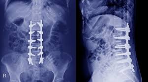 Anatomia topograficzna i funkcjonalna rdzenia kręgowego i nerwów rdzeniowych: Uraz Rdzenia Kregowego Uszkodzenie Przerwanie Objawy Skutki Leczenie Rehabilitacja Swiat Rehabilitacji Fizioterapia Profilaktyka