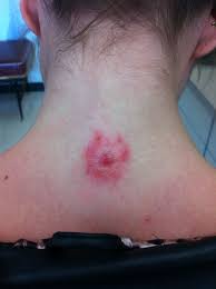 Infected Neck Dermal Watercolor Tattoo Piercing Tattoos