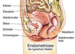 Endometriose ist ein zustand, bei dem sich endometriumgewebe außerhalb der gebärmutter befindet. Endometriose Modernste Diagnose Und Behandlung In Heidelberg