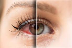 Check spelling or type a new query. Eyes Like The Sahara How To Stop Dry Eyes When You Wear Contacts Lenspure