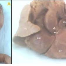 Pdf Truncus Arteriosus Communis Report Of Three Cases And Review Of Literature