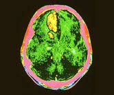 Nhs Choices Get Behind The Headlines With Analysis Of A Story About Triggers For Sah Http Www Nhs Uk News 2011 0 Subarachnoid Hemorrhage Hemorrhage Trigger