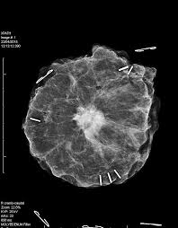 Being called back does not mean you definitely have cancer. This Is What Breast Cancer Looks Like On An X Ray Pics